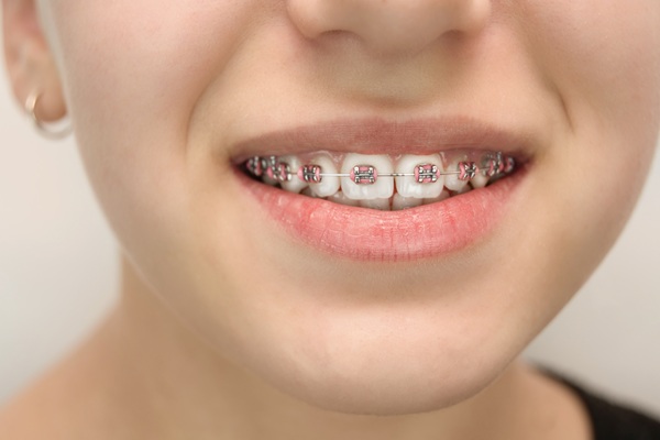 Get Ahead Of Your Orthodontic Care With Braces For Kids