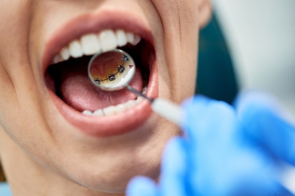 How Lingual Braces Work And What To Expect During Treatment